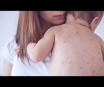 Replay Rougeole : cas en hausse de 47 % en Europe et Asie centrale l'an dernier, selon l'OMS