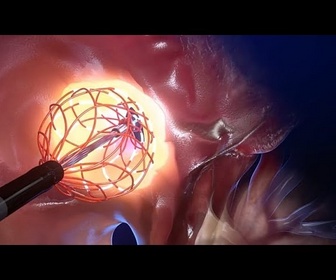 Replay En plein cœur : un cathéter innovant conçu pour révolutionner le traitement de l'arythmie